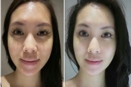 gluta injection dubai|Glutathione Skin Glowing Injections .
